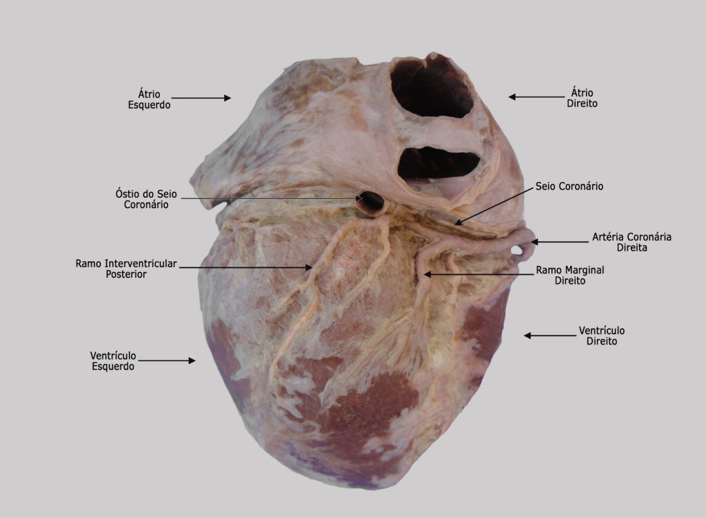 Artéria Coronária Direita – Ramo Interventricular Posterior