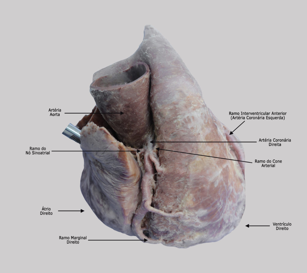 Artéria Coronária Direita – Ramo do Nó Sinoatrial